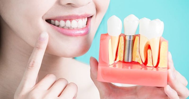 Best Dental Implant Options in Australia